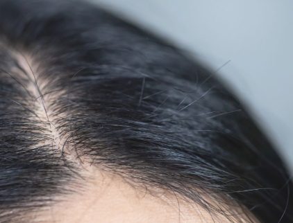 Thinning hair, how to strengthen it